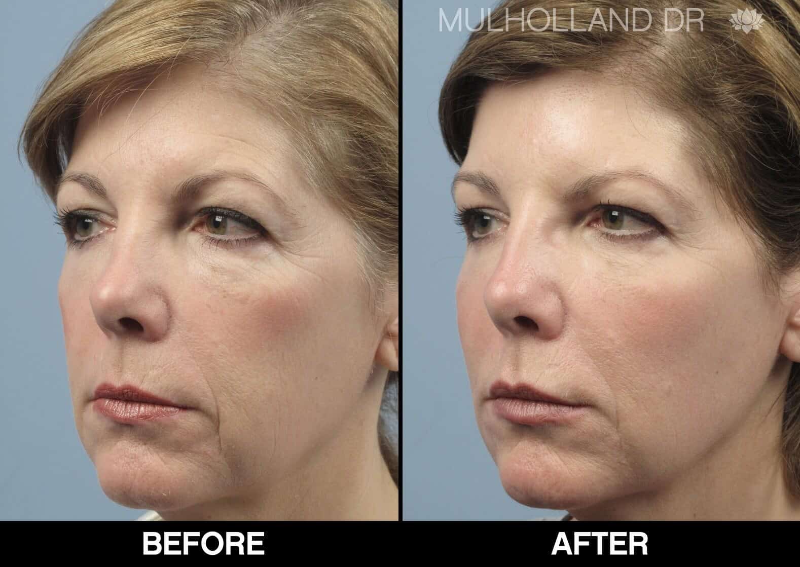 Dermal Fillers Before and After Gallery – Photo 35