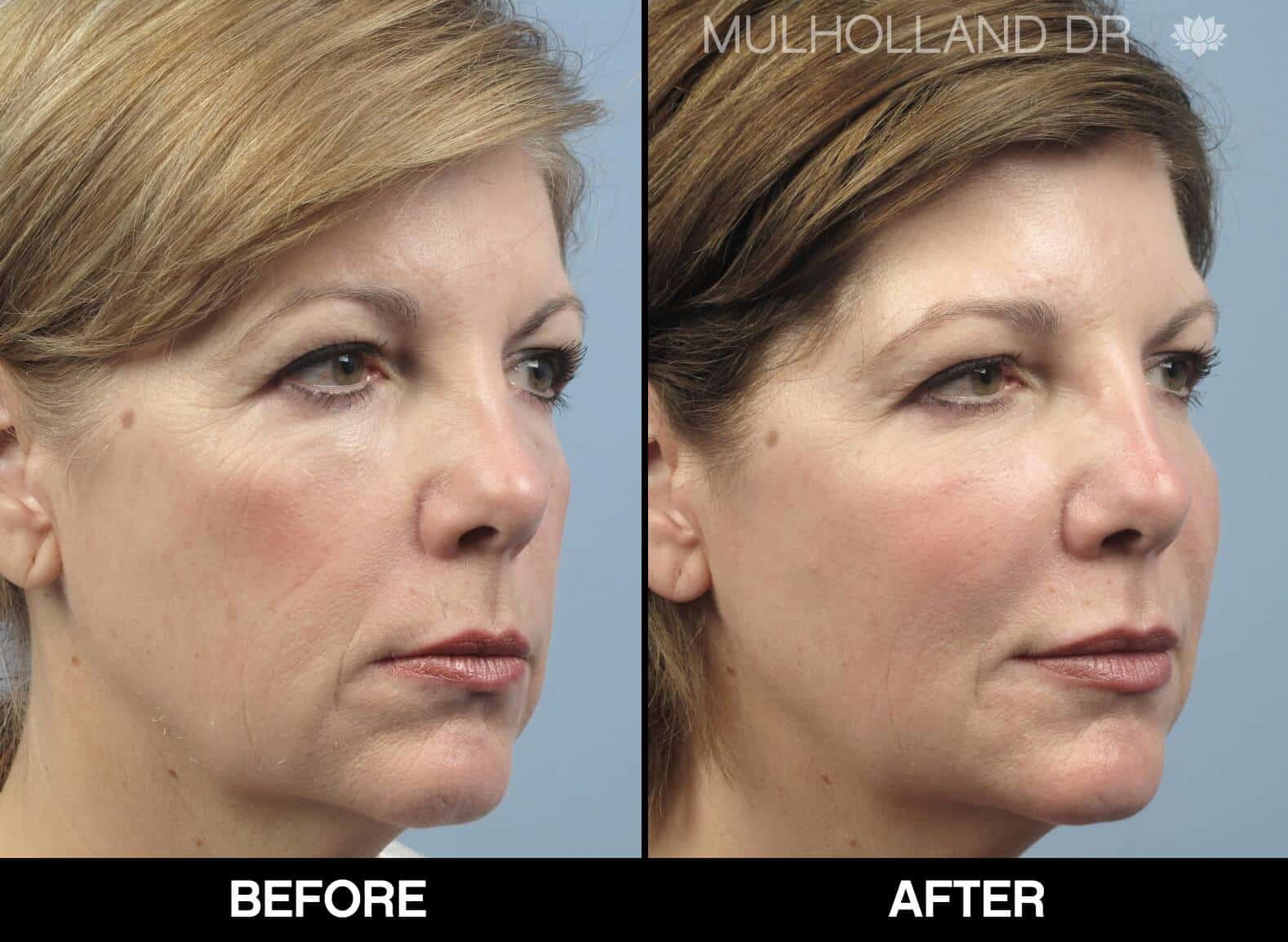 Dermal Fillers Before and After Gallery – Photo 31