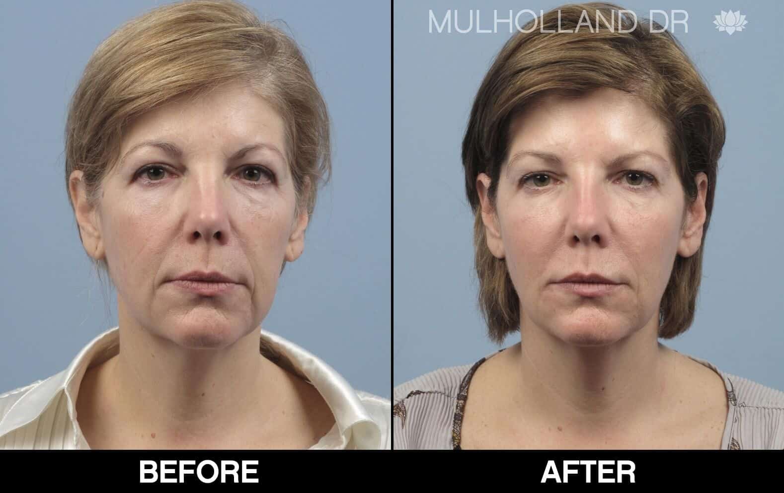 Dermal Fillers Before and After Gallery – Photo 29