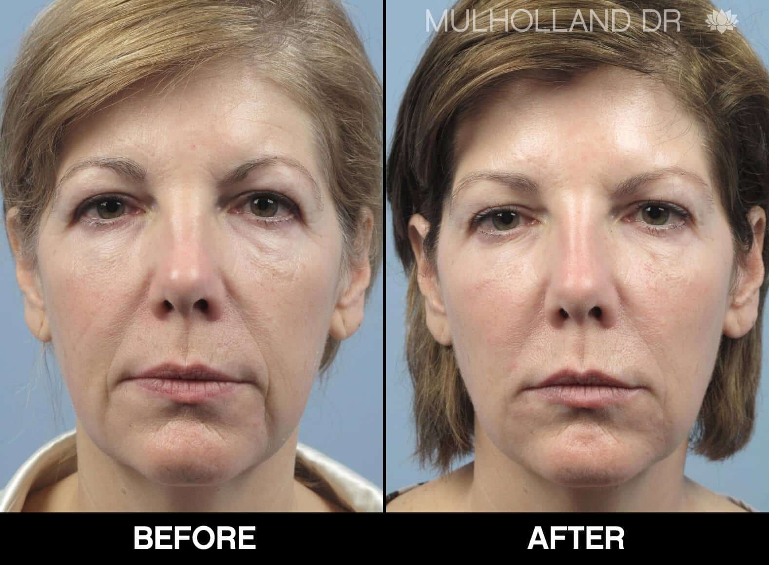 Dermal Fillers Before and After Gallery – Photo 28