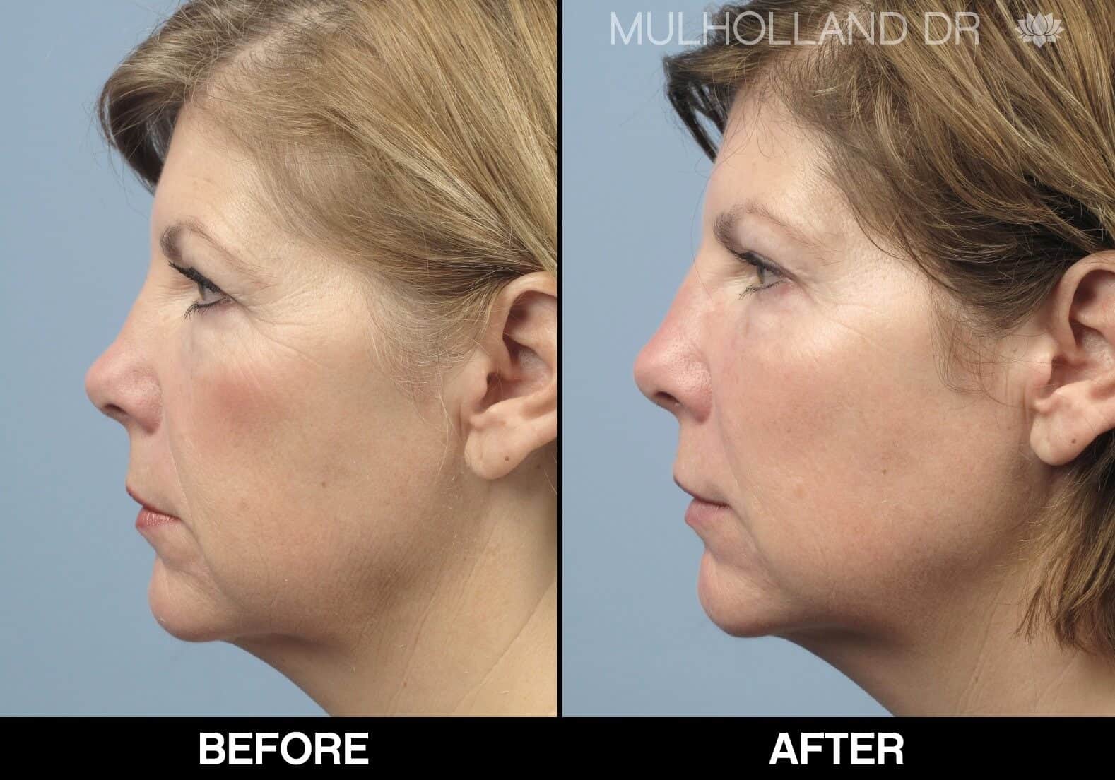 Dermal Fillers Before and After Gallery – Photo 25