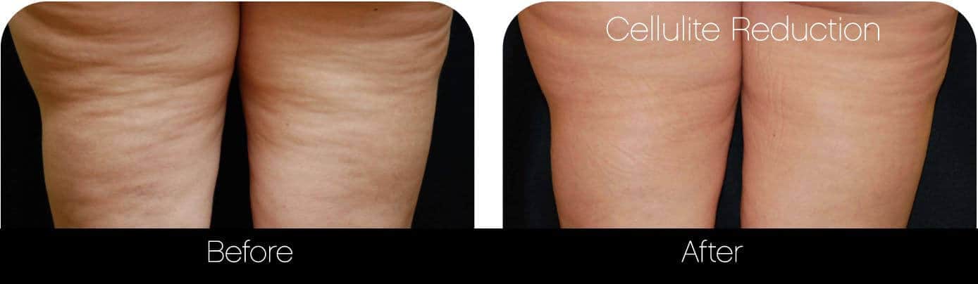 Cellulite Reduction Before and After Gallery – Photo 7