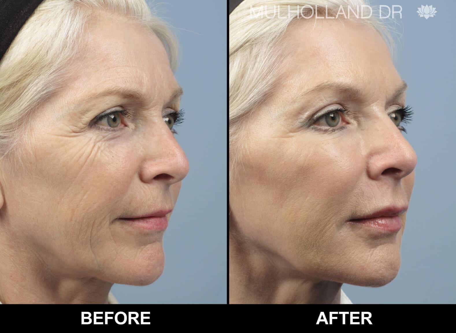 Fractional CO2 Laser Before and After Gallery – Photo 68