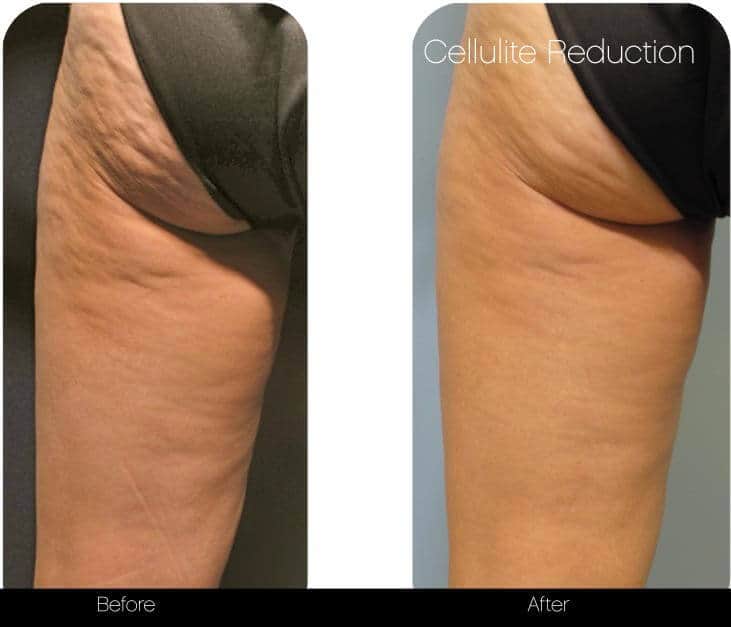 Cellulite reduction before and after