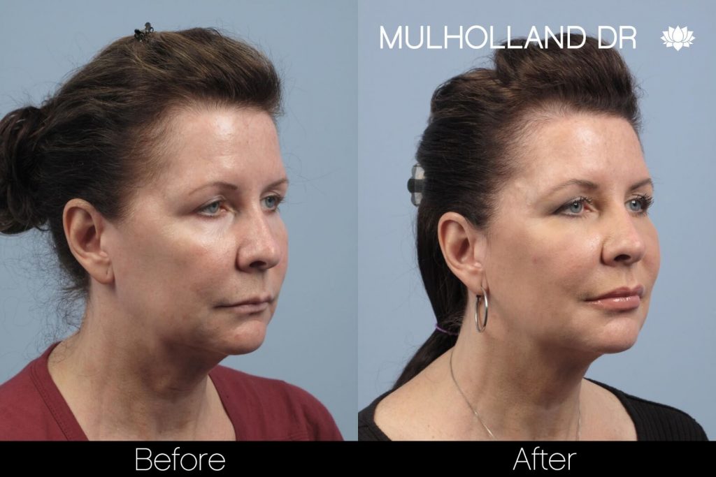 Dermal Fillers Before and After