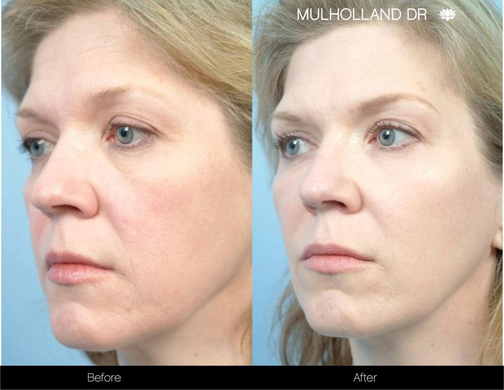 Fractional CO2 Laser in Toronto | Laser Skin Resurfacing