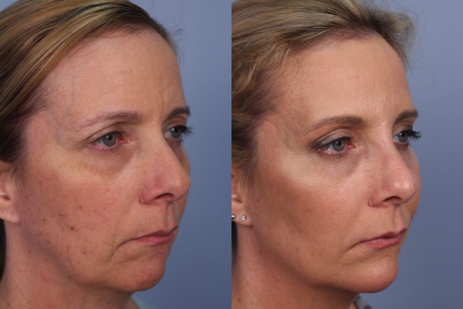 Best Dermal Fillers In Toronto SpaMedica