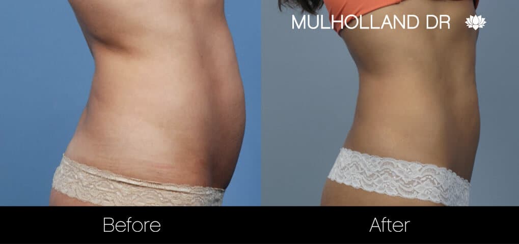 Non-Surgical Liposuction - Patient 10