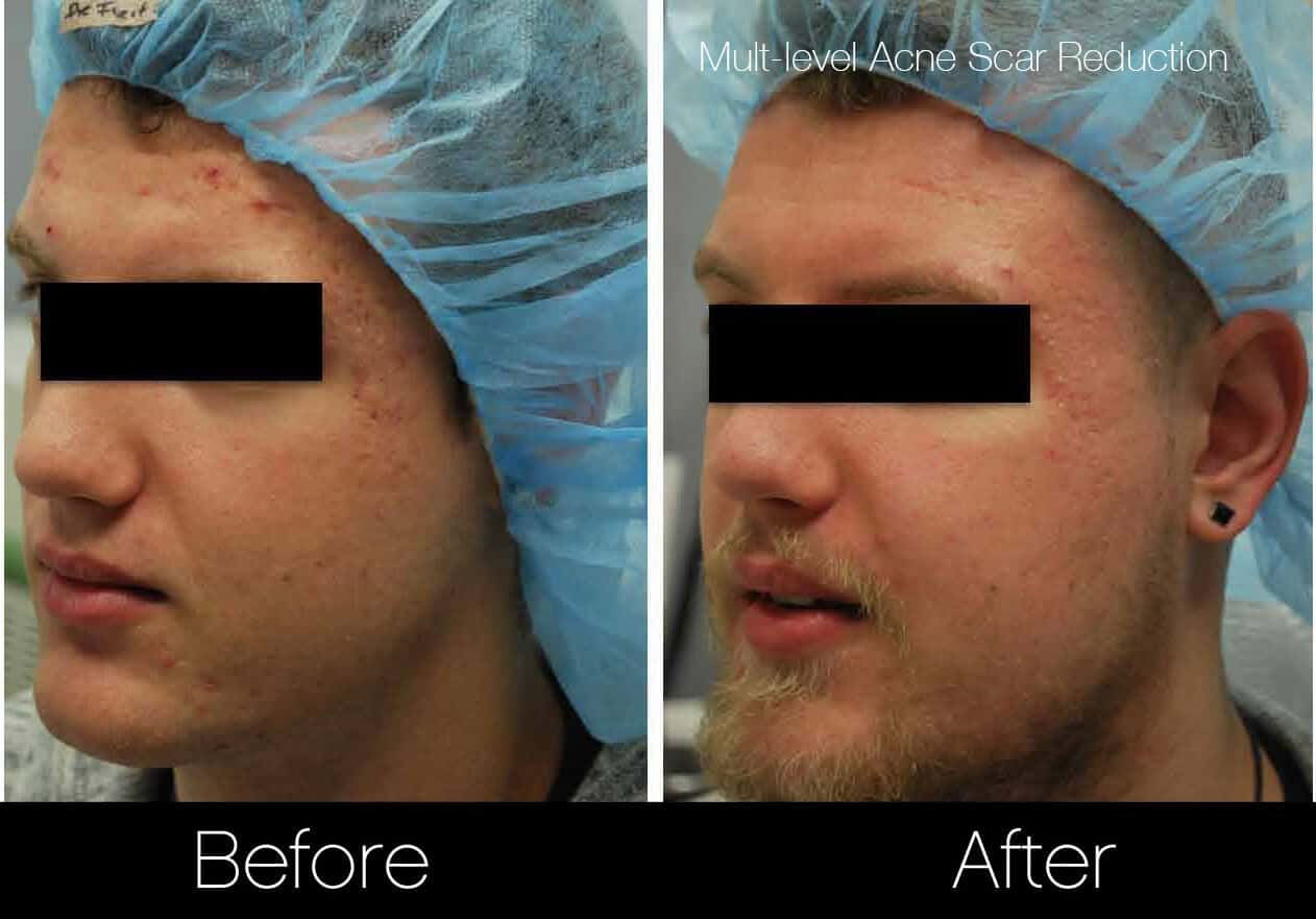 Acne Scar Treatments - Before and After Gallery – Photo 11