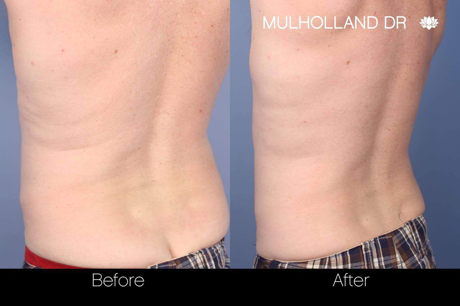 SculpSure - Before and After Gallery – Photo 9