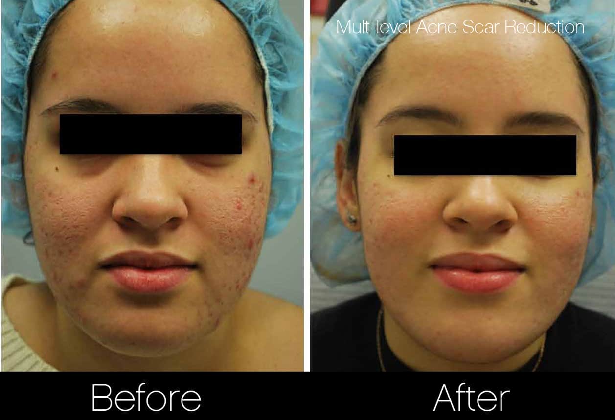 Acne Scar Treatments - Before and After Gallery – Photo 5