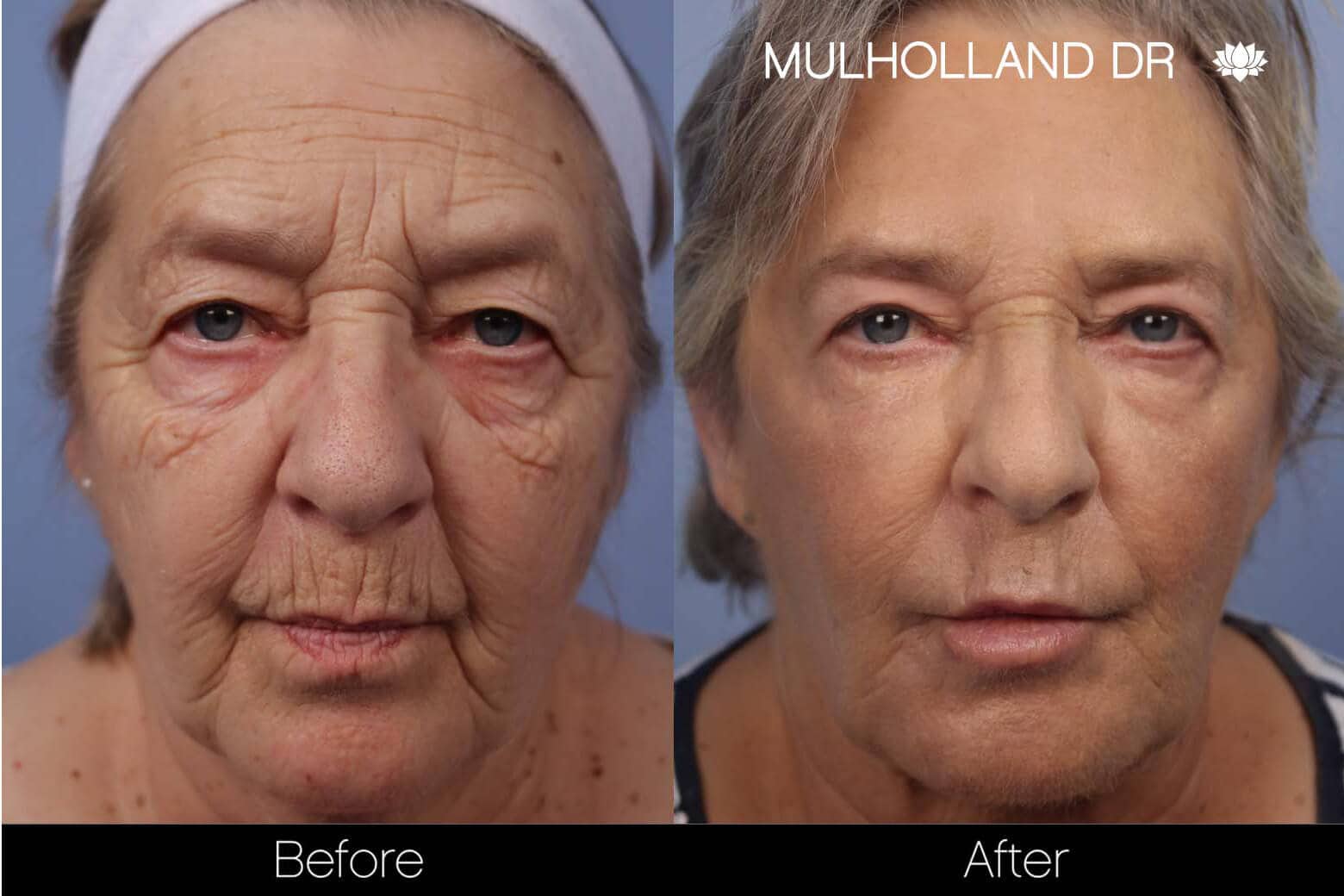 Facial Resurfacing and Rejuvenation - Before and After Gallery – Photo 4