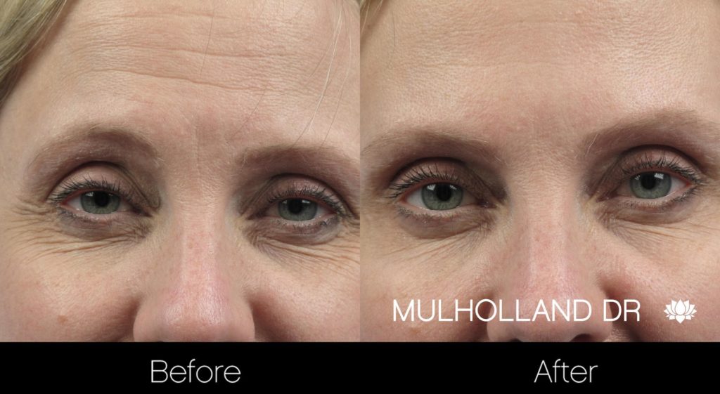 Botox Injectable - Before and After Gallery – Photo 1