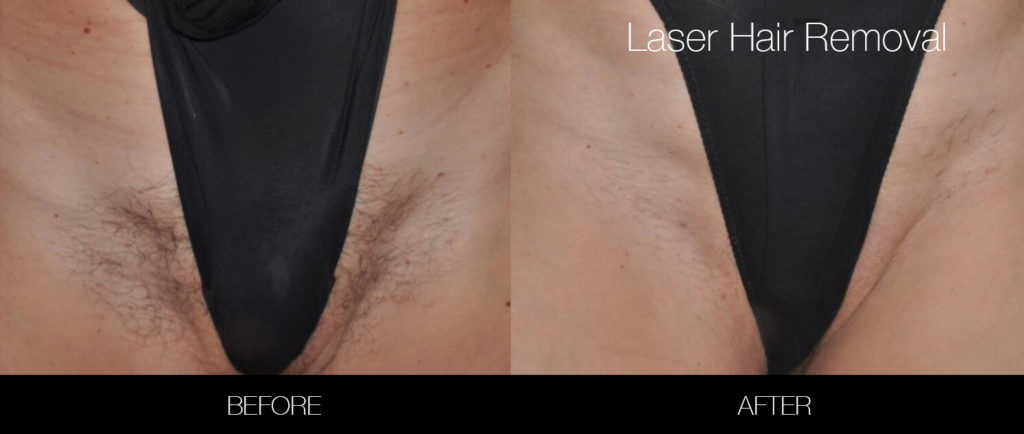 Bikini Brazilian Laser Hair Removal Archives Spamedica