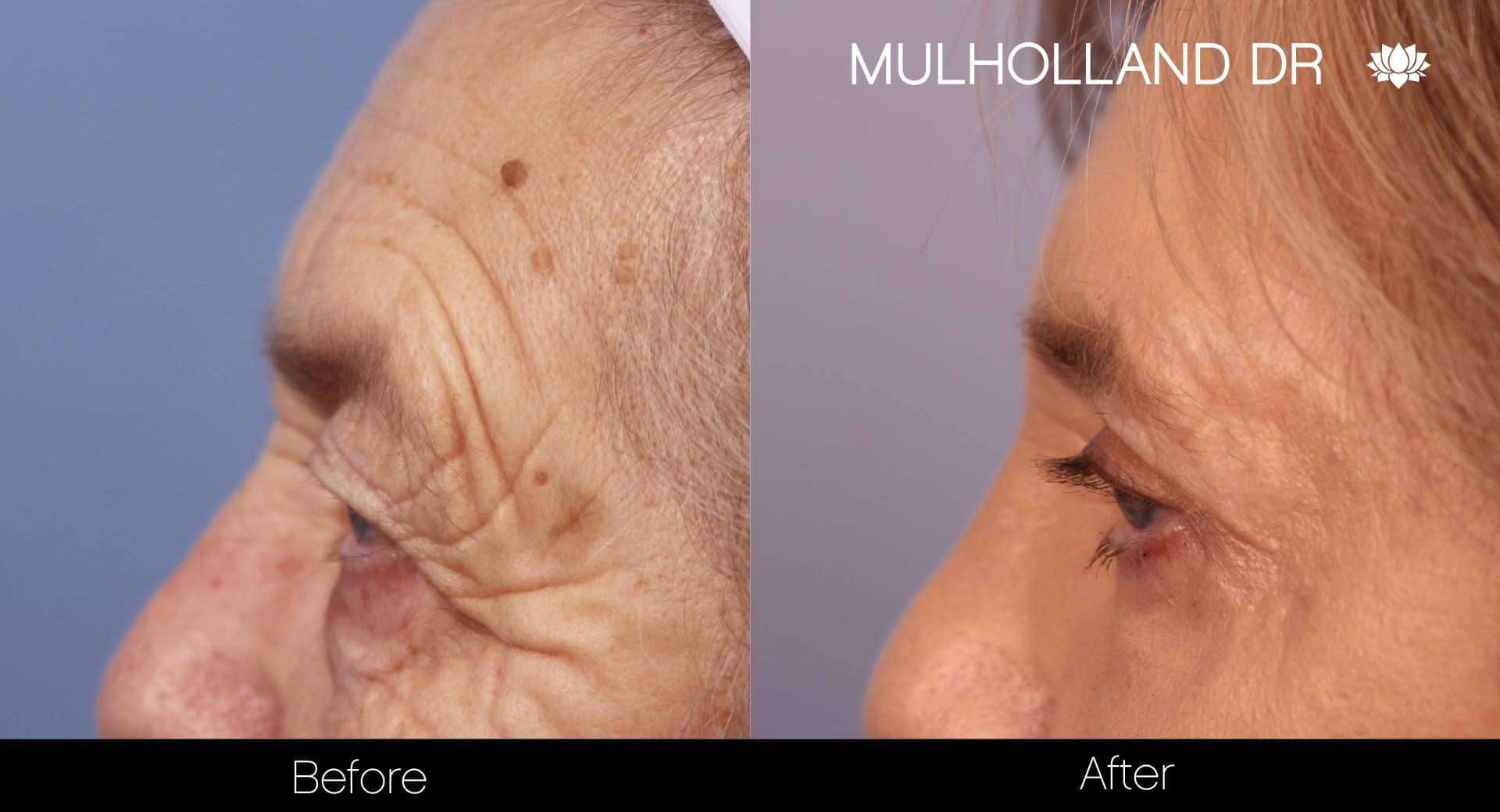 Laser Skin Resurfacing - Before and After Gallery – Photo 10