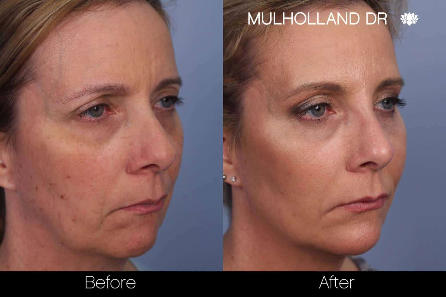 FotoFacial - Before and After Gallery – Photo 6