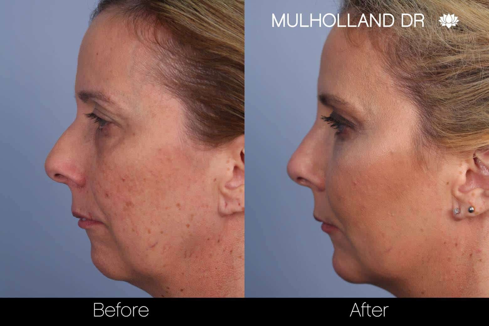 FotoFacial - Before and After Gallery – Photo 8