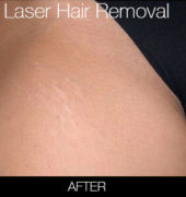 female brazilian laser hair removal before and after