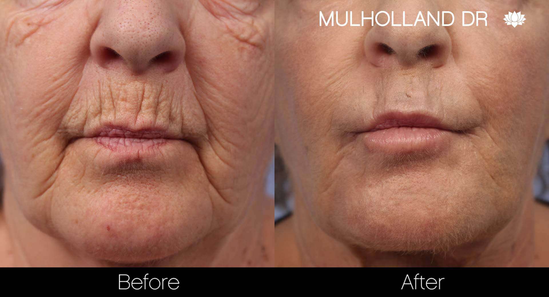 Facial Resurfacing and Rejuvenation - Before and After Gallery – Photo 2