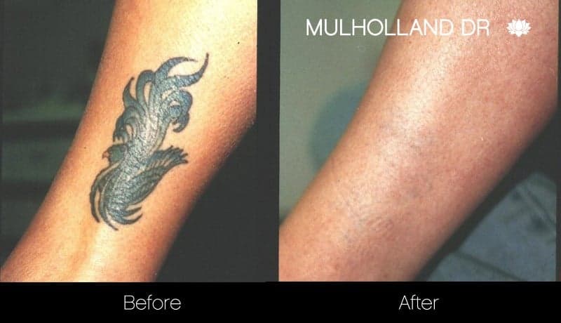 Before  After Photos of Sydney Laser Tattoo Removal Treatments