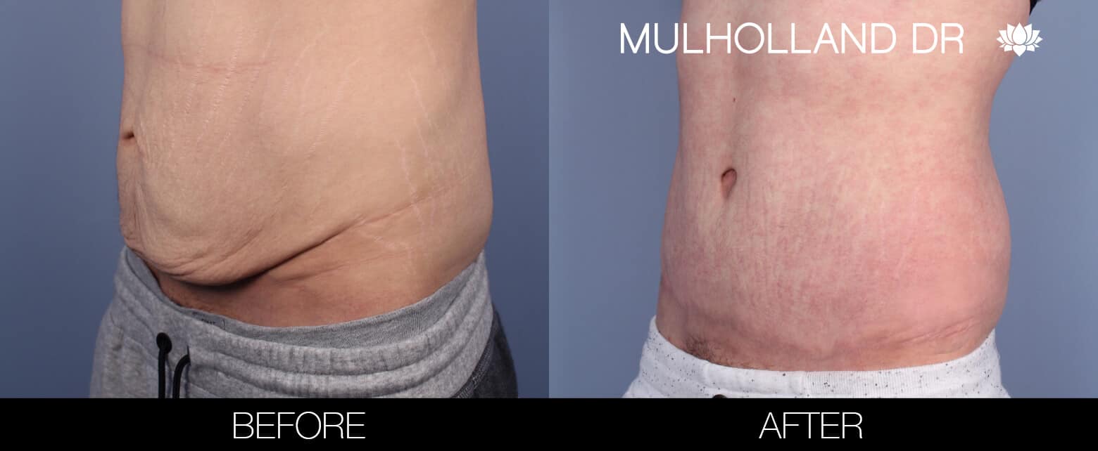 Male Tummy Tuck (Belt Lipectomy) - Before and After Gallery – Photo 2