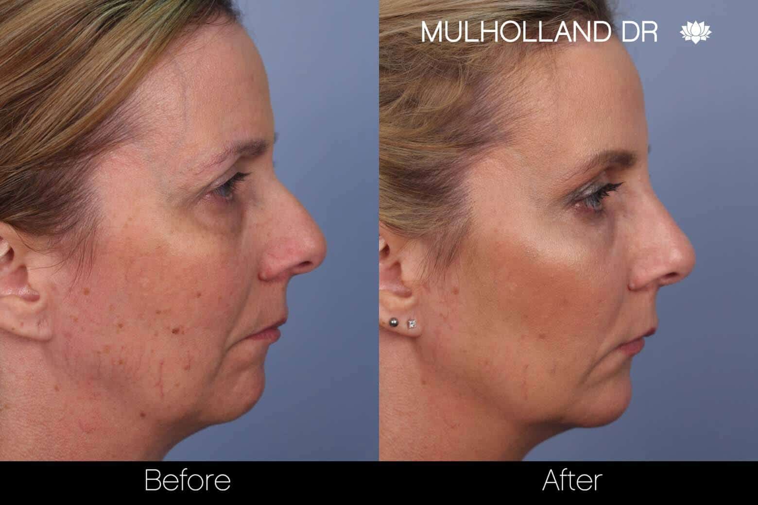 FotoFacial - Before and After Gallery – Photo 9