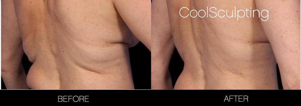 CoolSculpting - Before and After Gallery – Photo 4