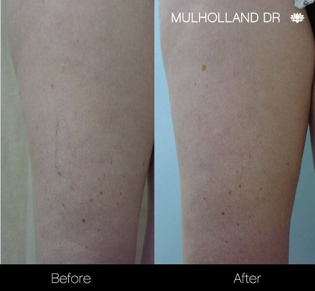 Leg Vein Reduction - Patient 4