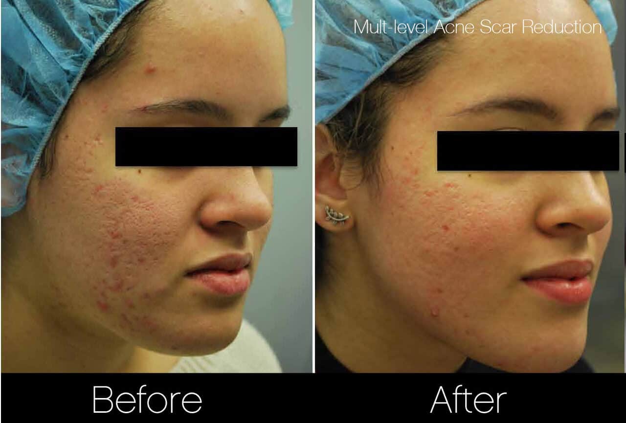 Acne Scar Treatments - Before and After Gallery – Photo 4