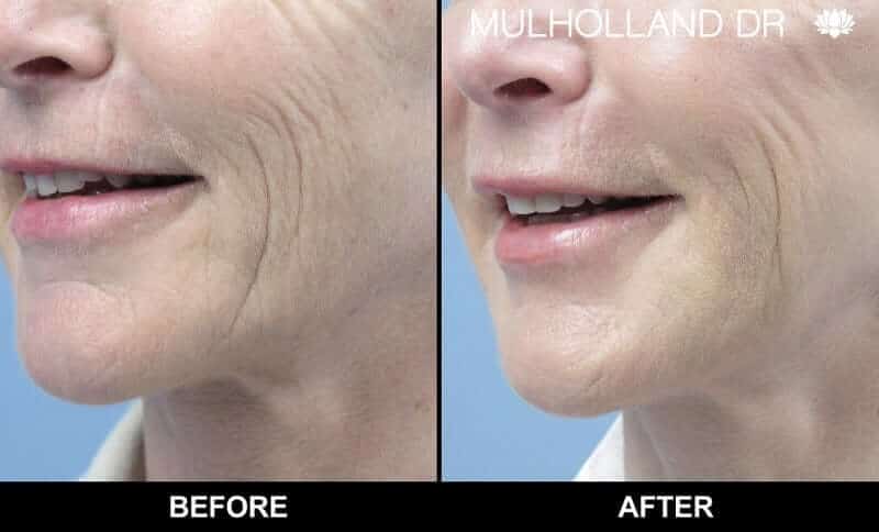 Non-Surgical Facelift - Before and After Gallery – Photo 5