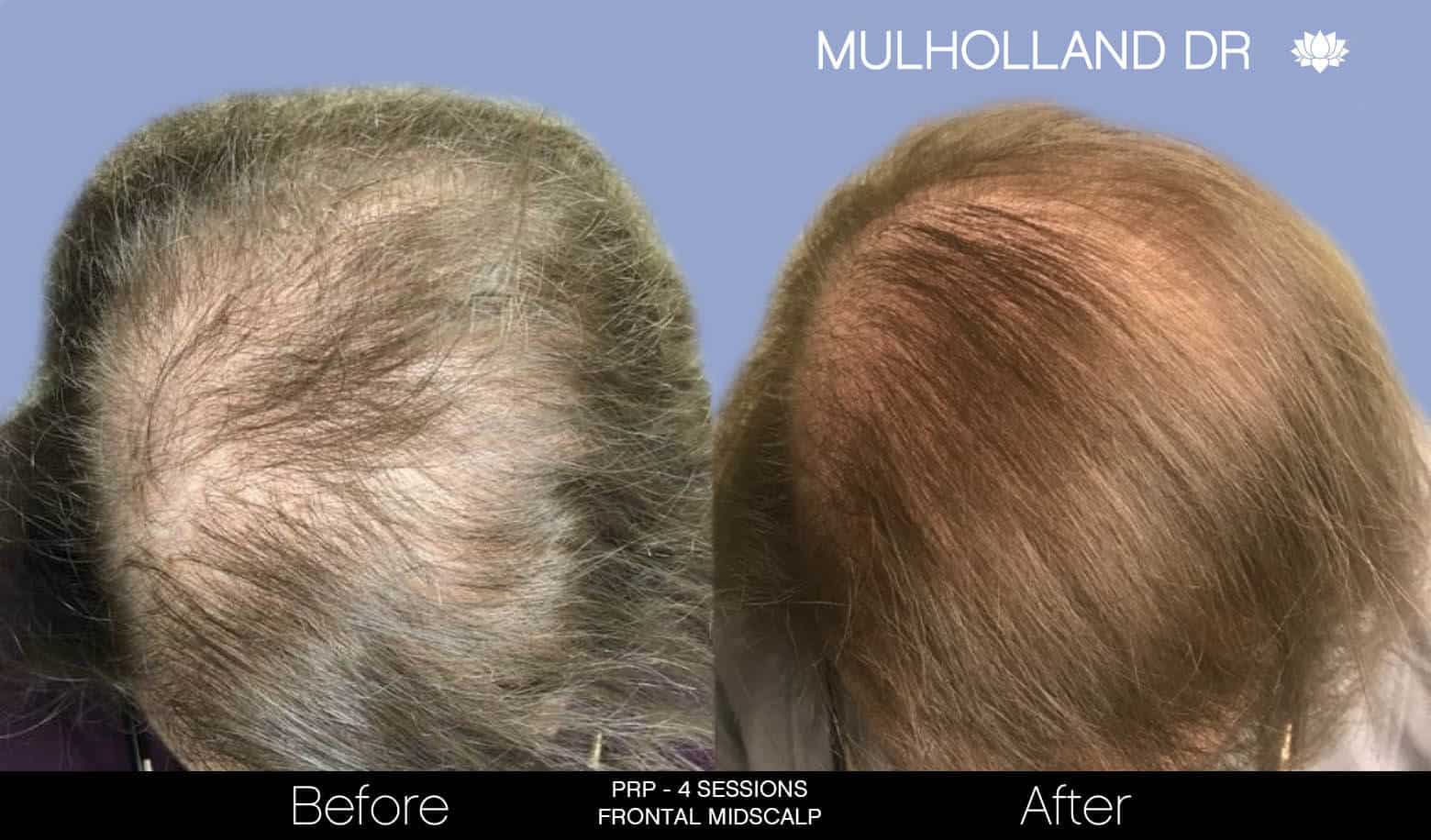 Non-Surgical Hair Restoration - Patient Before and After Gallery – Photo 6