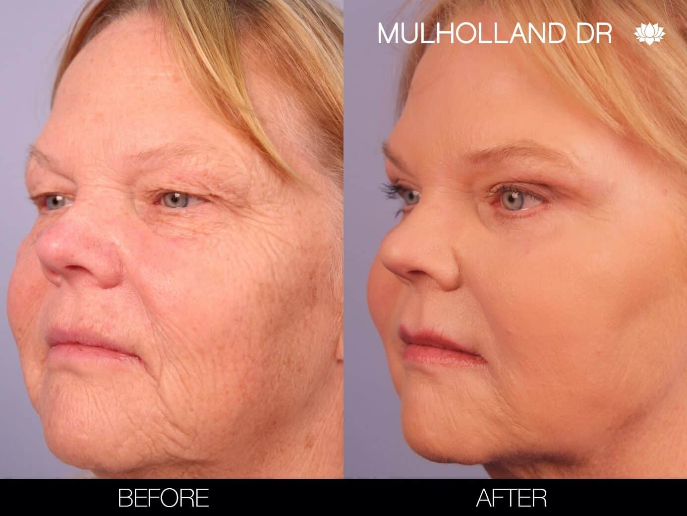 Laser Skin Resurfacing - Patient 1 - Spamedica