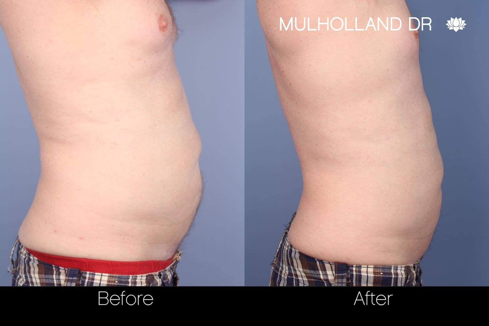 SculpSure - Before and After Gallery – Photo 7