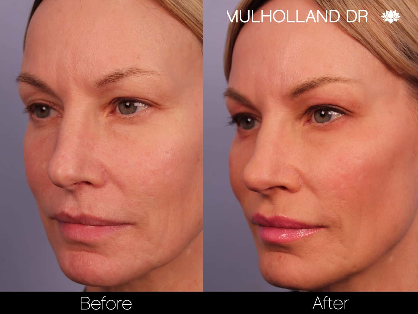 Rosacea Treatment - Patient Before and After Gallery – Photo 5