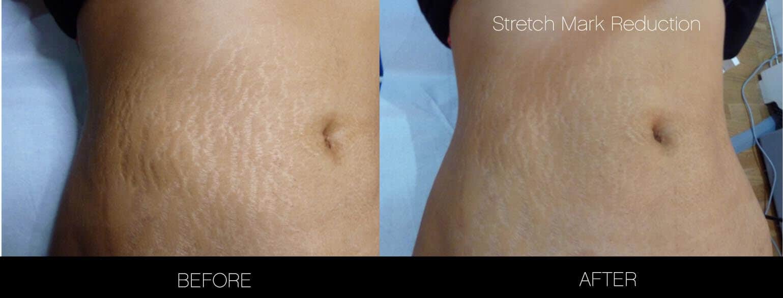 Image7 Non Surgical Laser Skin Treatmens Stretch Mark Reduction 