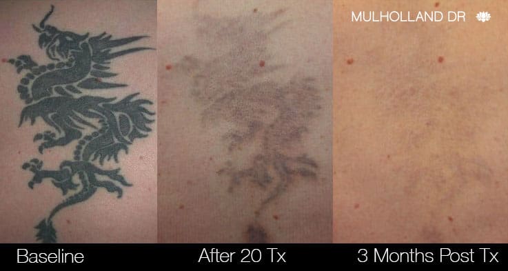 Tattoo Removal Before  After  Charlotte Huntersville NC Saluja Cosmetic  and Laser Center