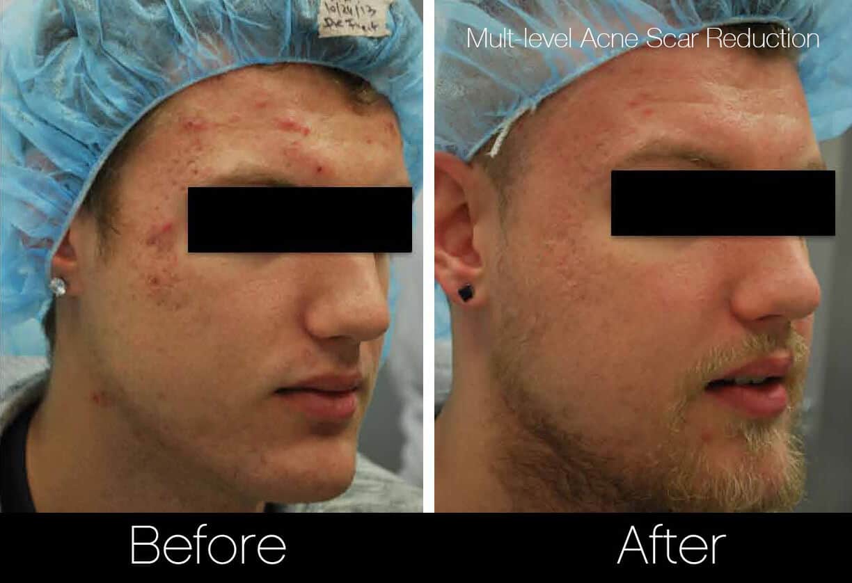 Acne Scar Treatments - Before and After Gallery – Photo 10