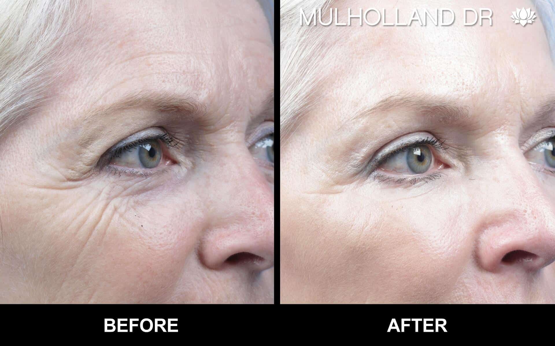 Microdermabrasion - Before and After Gallery – Photo 10