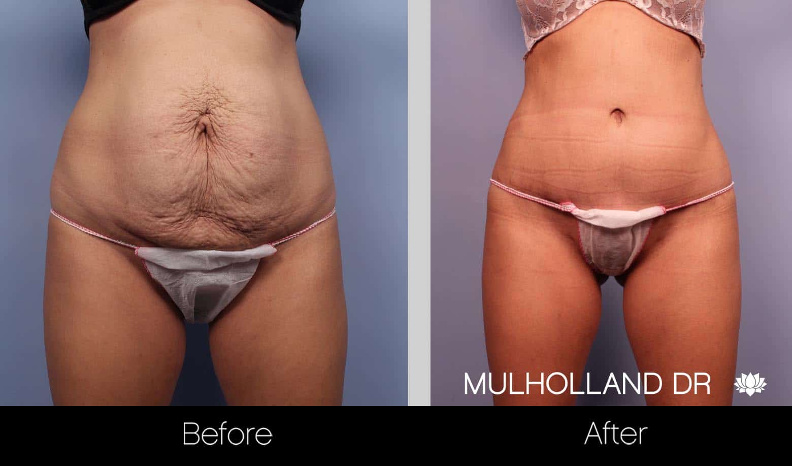 Mini Tummy Tuck - Before and After Gallery – Photo 10