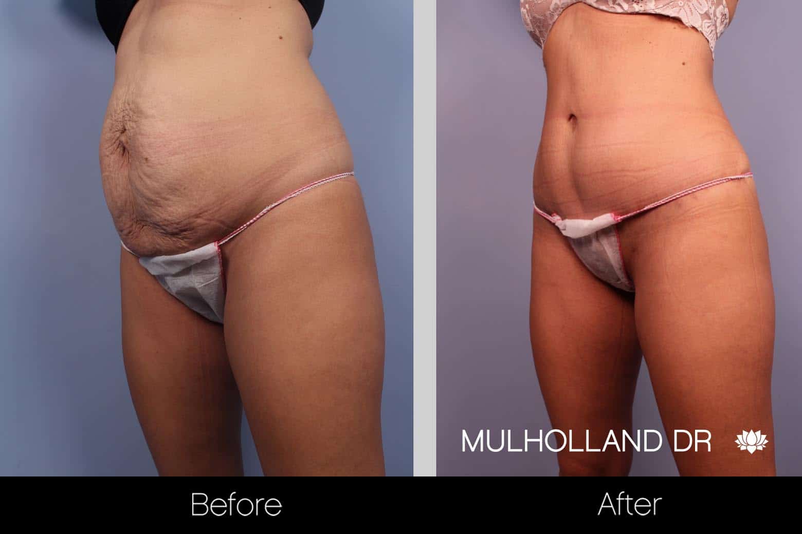 Mini Tummy Tuck - Before and After Gallery – Photo 11