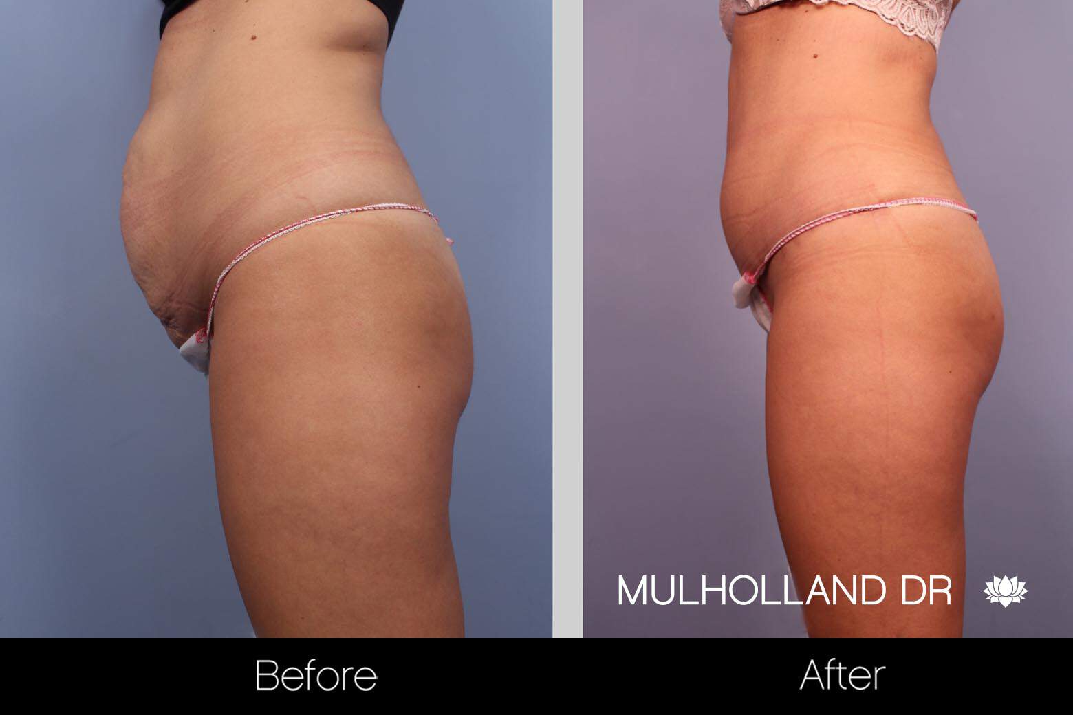 Mini Tummy Tuck - Before and After Gallery – Photo 12