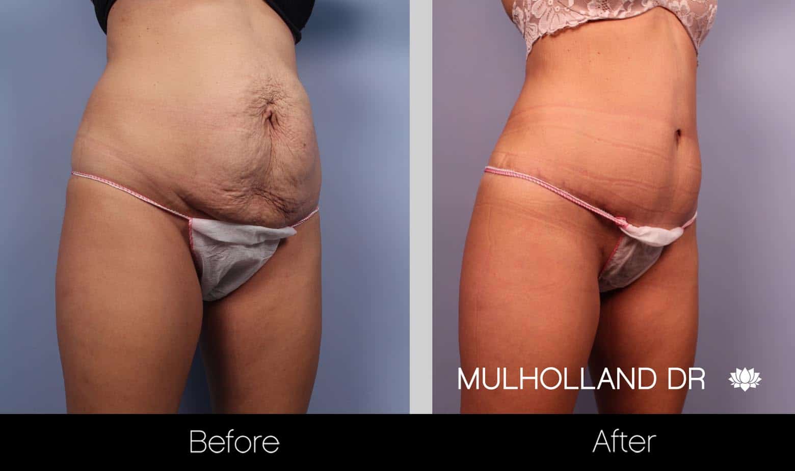 Mini Tummy Tuck - Before and After Gallery – Photo 13