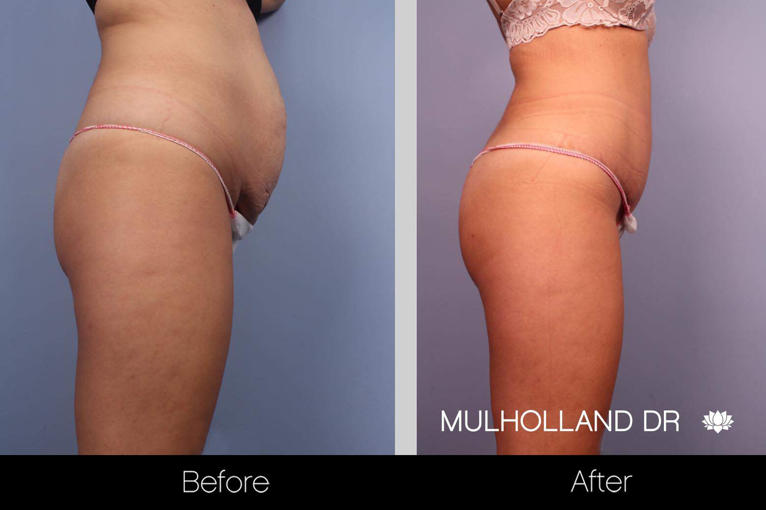 Mini Tummy Tuck - Before and After Gallery – Photo 14