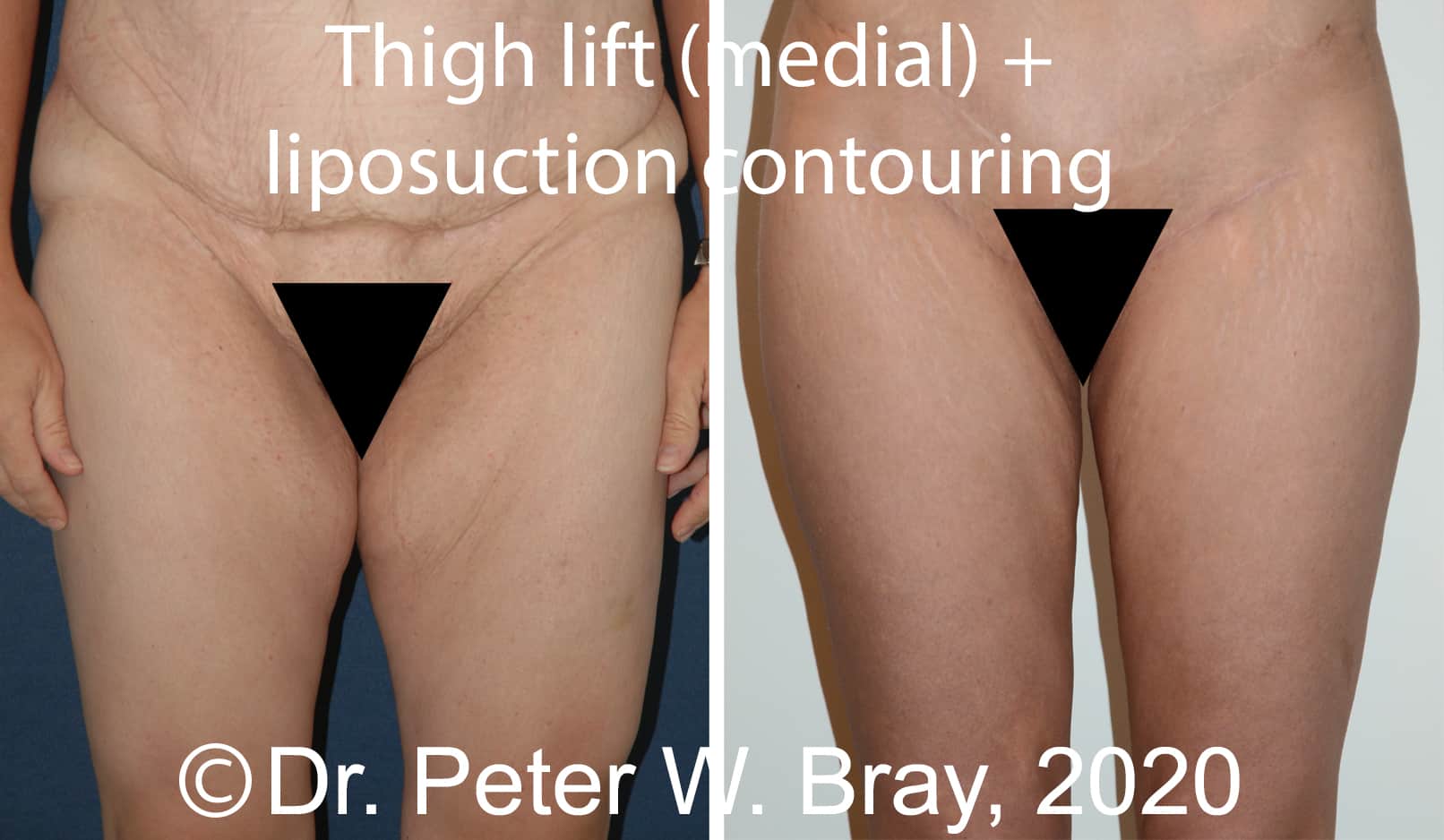 Inner Thigh Liposuction Incisions: Where Are They Made?