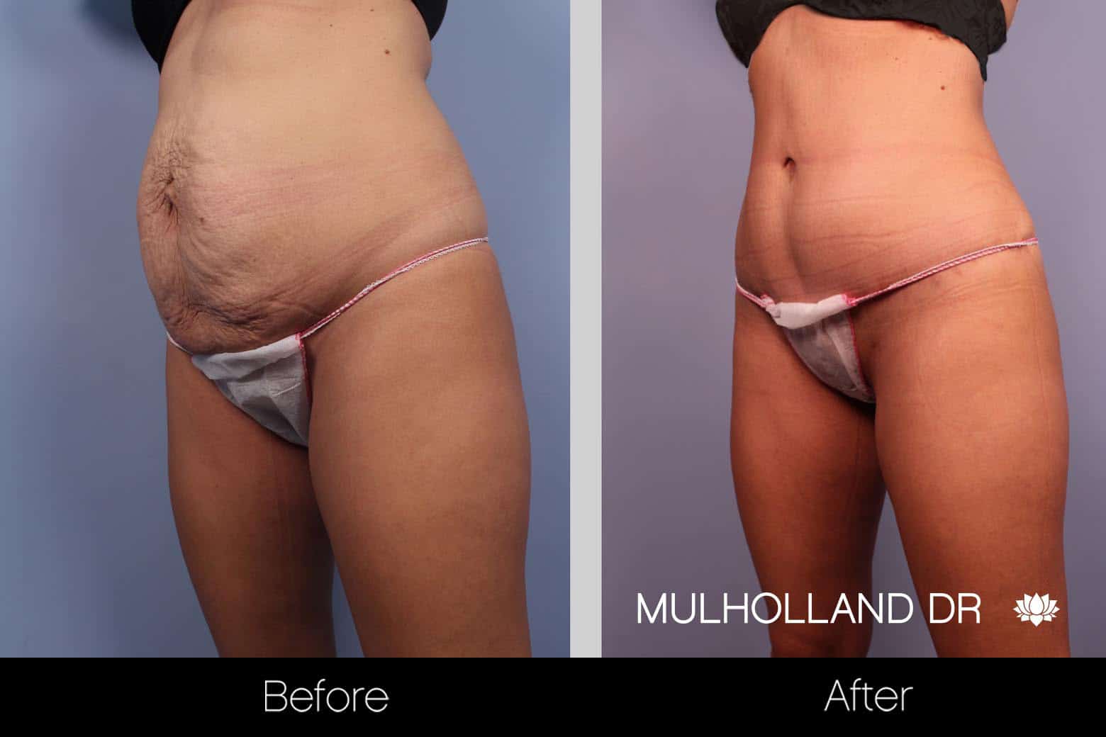 Mini Tummy Tuck - Before and After Gallery – Photo 5