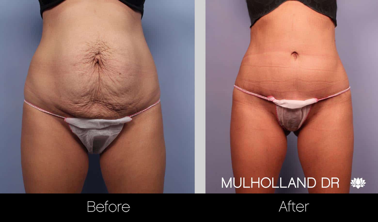 Mini Tummy Tuck - Before and After Gallery – Photo 6