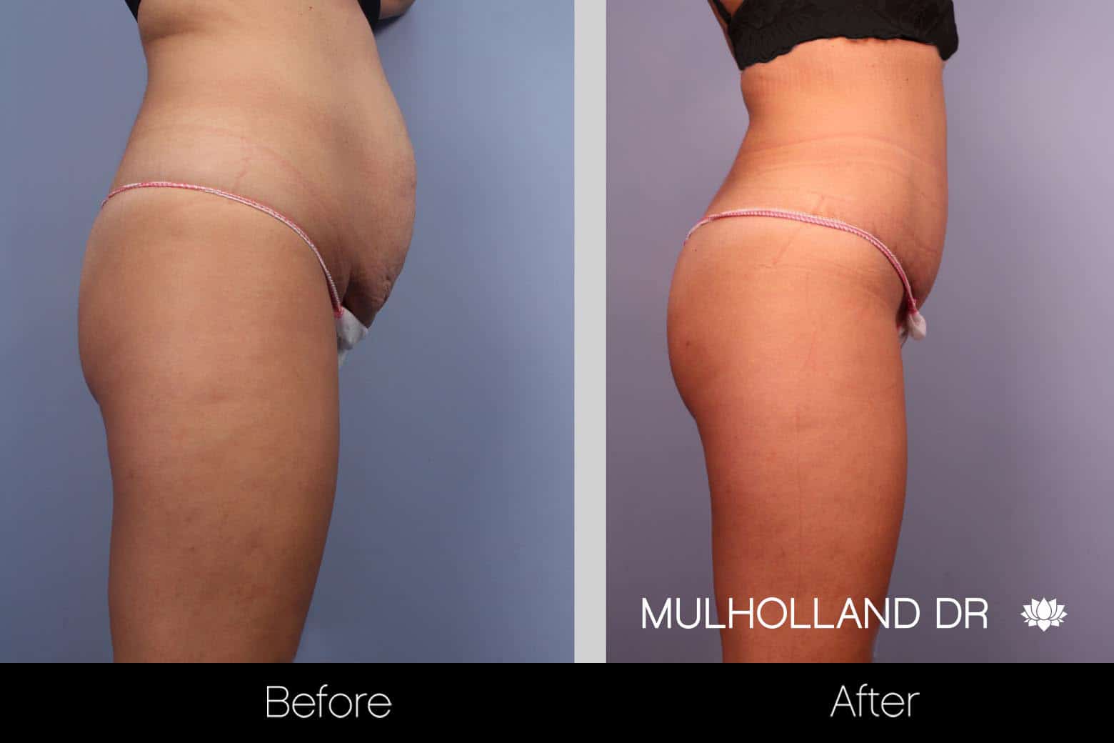 Mini Tummy Tuck - Before and After Gallery – Photo 7