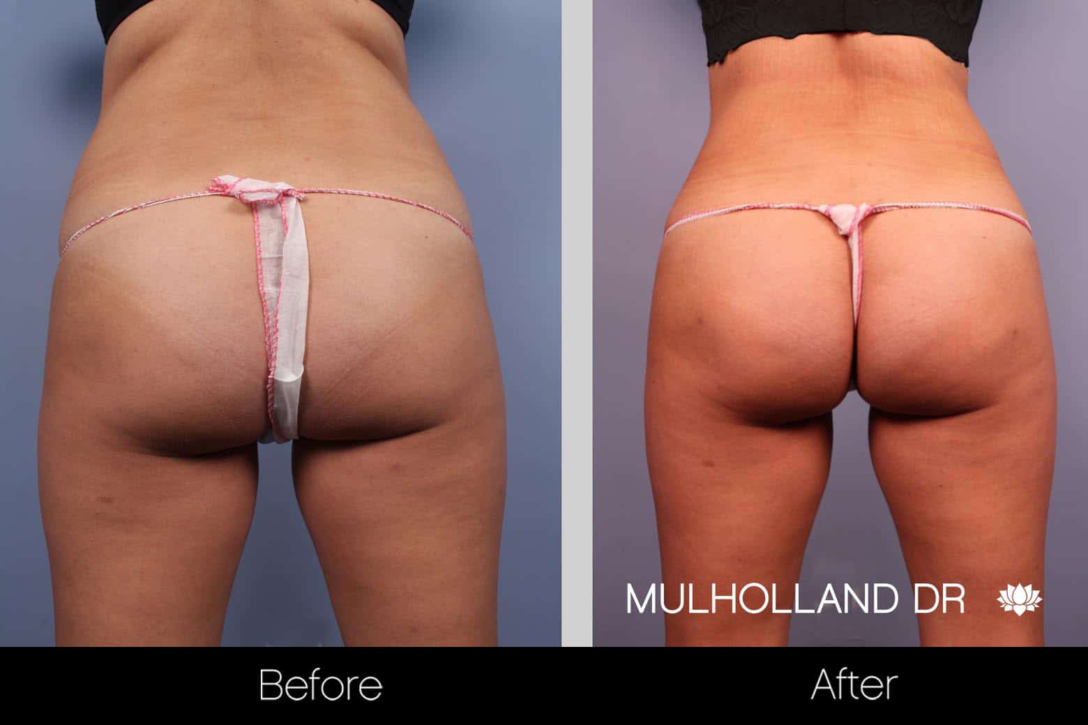 Mini Tummy Tuck - Before and After Gallery – Photo 8