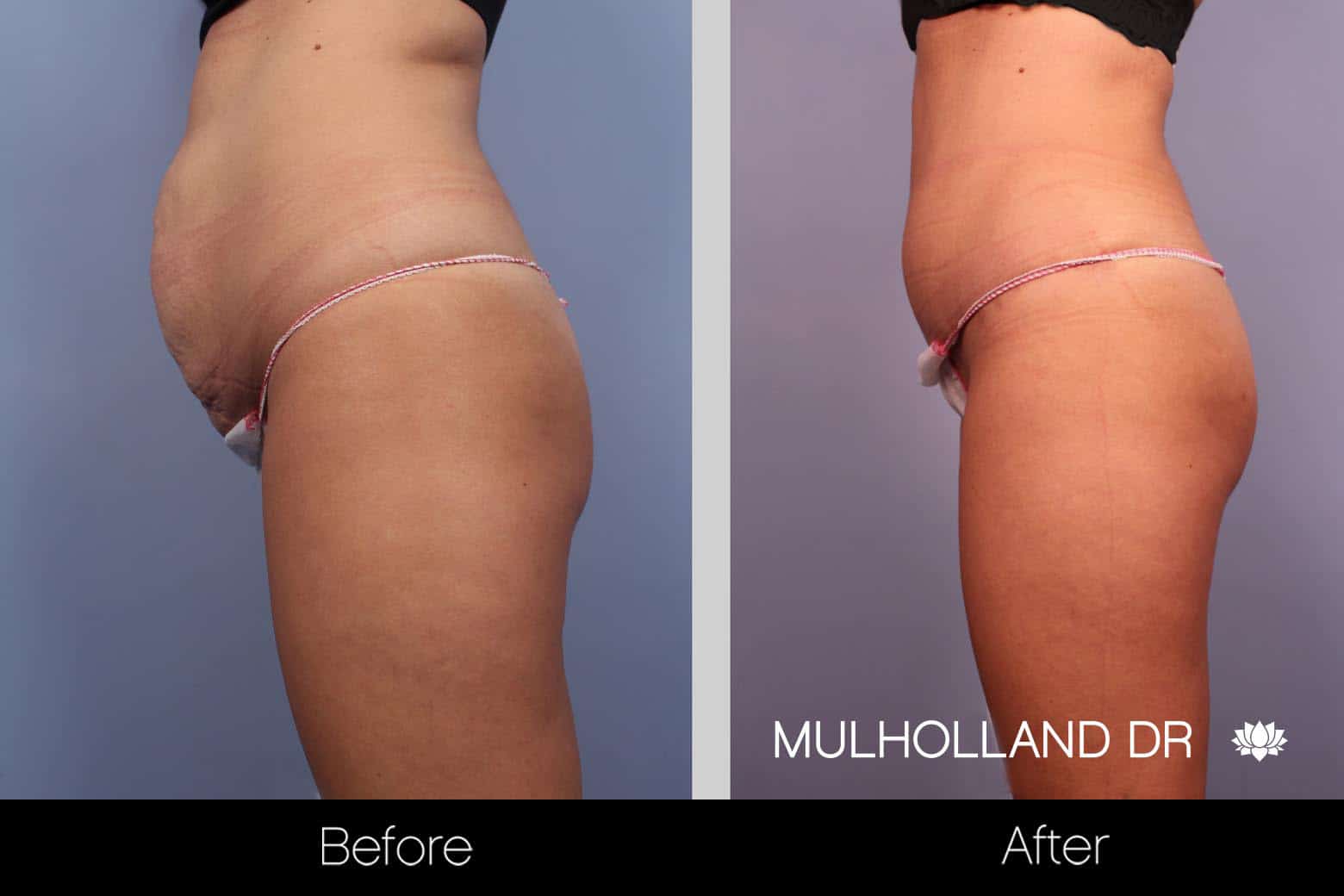 Mini Tummy Tuck - Before and After Gallery – Photo 9