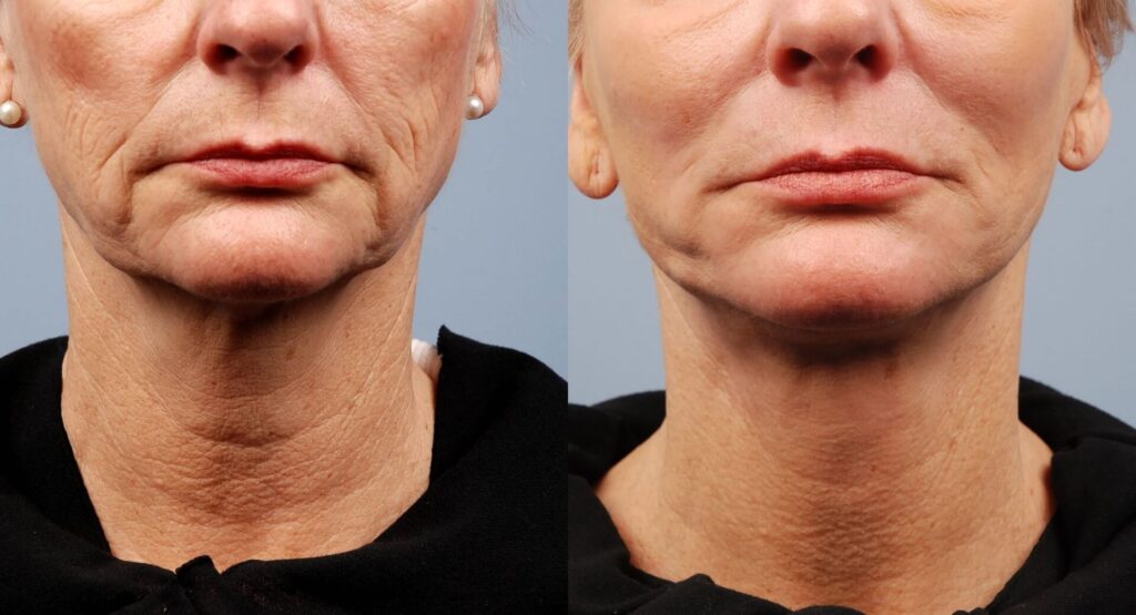 NonSurgical Facelift Toronto See Before & Afters SpaMedica